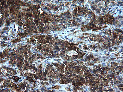 FGG / Fibrinogen Gamma Antibody - IHC of paraffin-embedded Carcinoma of Human thyroid tissue using anti-FGG mouse monoclonal antibody. (Heat-induced epitope retrieval by 1 mM EDTA in 10mM Tris, pH8.5, 120°C for 3min).