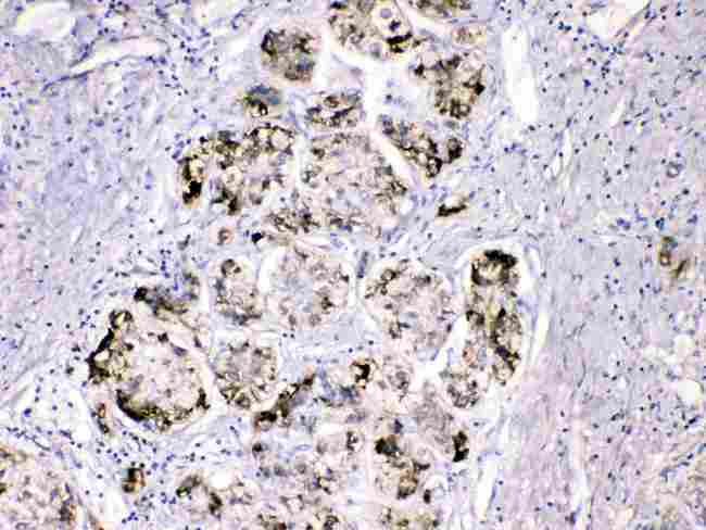 FGG / Fibrinogen Gamma Antibody - FGG was detected in paraffin-embedded sections of human liver cancer tissues using rabbit anti- FGG Antigen Affinity purified polyclonal antibody