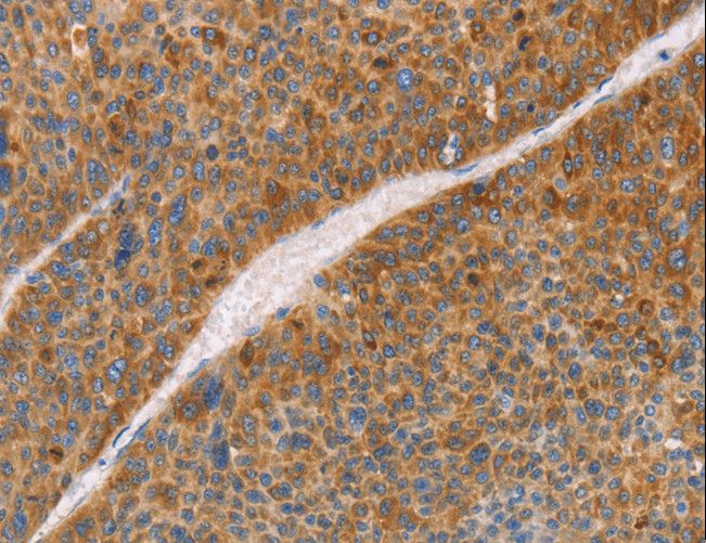 FGL1 / Hepassocin Antibody - Immunohistochemistry of paraffin-embedded Human liver cancer using FGL1 Polyclonal Antibody at dilution of 1:50.