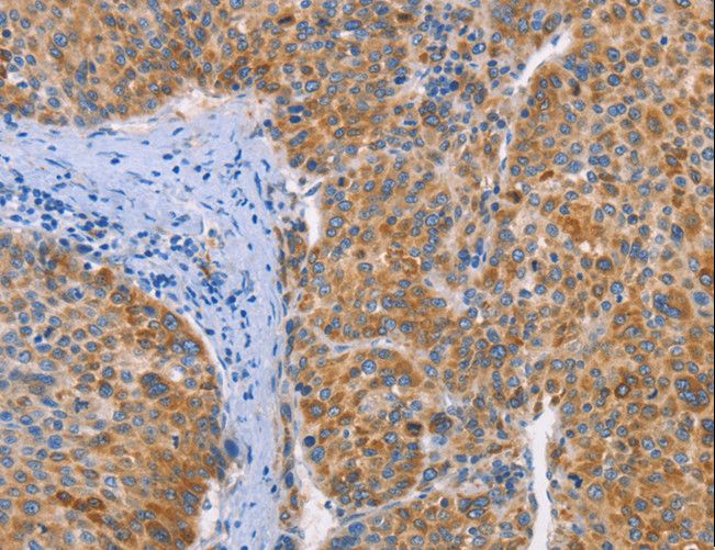 FGL1 / Hepassocin Antibody - Immunohistochemistry of paraffin-embedded Human liver cancer using FGL1 Polyclonal Antibody at dilution of 1:25.
