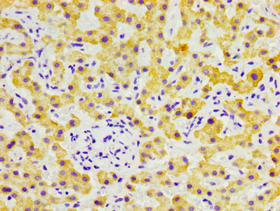 FGL1 / Hepassocin Antibody - Immunohistochemistry image at a dilution of 1:300 and staining in paraffin-embedded human liver cancer performed on a Leica BondTM system. After dewaxing and hydration, antigen retrieval was mediated by high pressure in a citrate buffer (pH 6.0) . Section was blocked with 10% normal goat serum 30min at RT. Then primary antibody (1% BSA) was incubated at 4 °C overnight. The primary is detected by a biotinylated secondary antibody and visualized using an HRP conjugated SP system.
