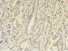 FGL2 Antibody - Immunohistochemistry of paraffin-embedded human lung cancer using antibody at 1:100 dilution.  This image was taken for the unconjugated form of this product. Other forms have not been tested.