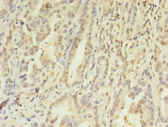 FGL2 Antibody - Immunohistochemistry of paraffin-embedded human lung cancer using FGL2 Antibody at dilution of 1:100