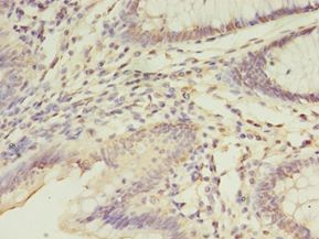 FGL2 Antibody - Immunohistochemistry of paraffin-embedded human colon cancer using antibody at 1:100 dilution.  This image was taken for the unconjugated form of this product. Other forms have not been tested.