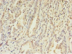 FGL2 Antibody - Immunohistochemistry of paraffin-embedded human lung cancer using antibody at 1:100 dilution.  This image was taken for the unconjugated form of this product. Other forms have not been tested.