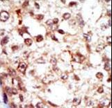 FGR Antibody - Formalin-fixed and paraffin-embedded human cancer tissue reacted with the primary antibody, which was peroxidase-conjugated to the secondary antibody, followed by AEC staining. This data demonstrates the use of this antibody for immunohistochemistry; clinical relevance has not been evaluated. BC = breast carcinoma; HC = hepatocarcinoma.
