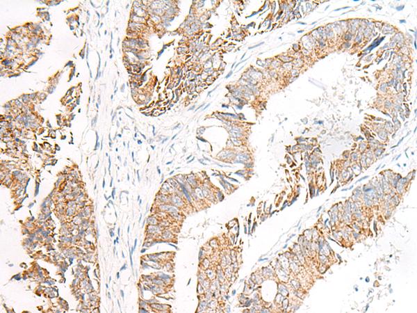 FGR Antibody - Immunohistochemistry of paraffin-embedded Human colorectal cancer tissue  using FGR Polyclonal Antibody at dilution of 1:70(×200)