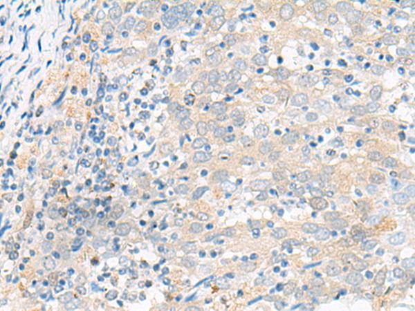 FGR Antibody - Immunohistochemistry of paraffin-embedded Human cervical cancer tissue  using FGR Polyclonal Antibody at dilution of 1:70(×200)