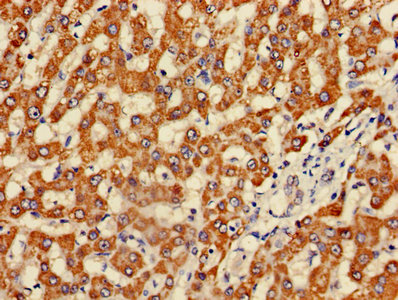 FH / Fumarase / MCL Antibody - Immunohistochemistry of paraffin-embedded human liver cancer using FH Antibody at dilution of 1:100