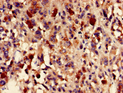 FH / Fumarase / MCL Antibody - Immunohistochemistry of paraffin-embedded human melanoma using FH Antibody at dilution of 1:100