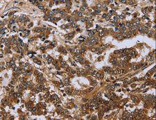 FH / Fumarase / MCL Antibody - Immunohistochemistry of paraffin-embedded Human liver cancer using FH Polyclonal Antibody at dilution of 1:30.