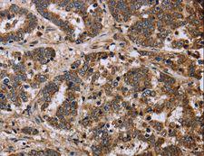 FH / Fumarase / MCL Antibody - Immunohistochemistry of paraffin-embedded Human liver cancer using FH Polyclonal Antibody at dilution of 1:40.