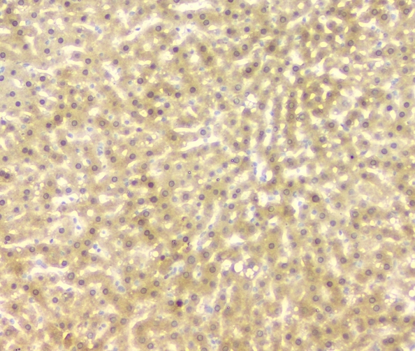 FH / Fumarase / MCL Antibody - IHC analysis of FH using anti-FH antibody. FH was detected in paraffin-embedded section of human intestinal cancer tissues. Heat mediated antigen retrieval was performed in citrate buffer (pH6, epitope retrieval solution) for 20 mins. The tissue section was blocked with 10% goat serum. The tissue section was then incubated with 1µg/ml mouse anti-FH Antibody overnight at 4°C. Biotinylated goat anti-mouse IgG was used as secondary antibody and incubated for 30 minutes at 37°C. The tissue section was developed using Strepavidin-Biotin-Complex (SABC) with DAB as the chromogen.