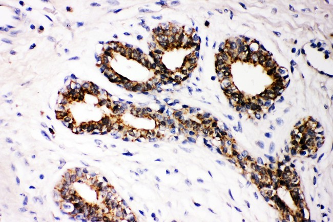FHIT Antibody - FHIT antibody IHC-paraffin: Human Mammary Cancer Tissue.