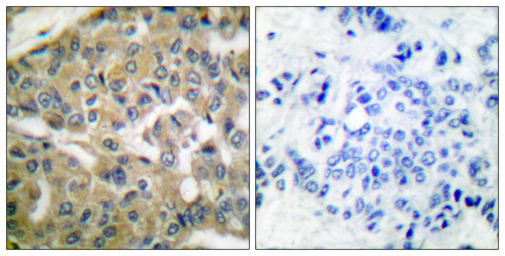 FHIT Antibody - Immunohistochemistry analysis of paraffin-embedded human breast carcinoma tissue, using FHIT Antibody. The picture on the right is blocked with the synthesized peptide.