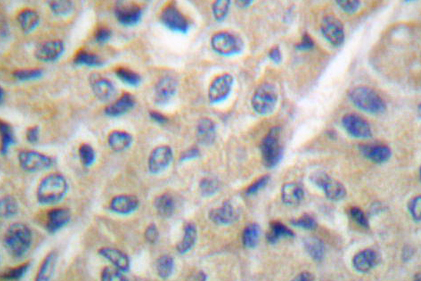 FHIT Antibody - IHC of FHIT (E116) pAb in paraffin-embedded human breast carcinoma tissue.