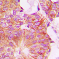 FHIT Antibody - Immunohistochemical analysis of FHIT staining in human breast cancer formalin fixed paraffin embedded tissue section. The section was pre-treated using heat mediated antigen retrieval with sodium citrate buffer (pH 6.0). The section was then incubated with the antibody at room temperature and detected using an HRP conjugated compact polymer system. DAB was used as the chromogen. The section was then counterstained with hematoxylin and mounted with DPX.