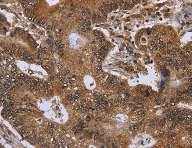 FHIT Antibody - Immunohistochemistry of paraffin-embedded Human colon cancer using FHIT Polyclonal Antibody at dilution of 1:30.