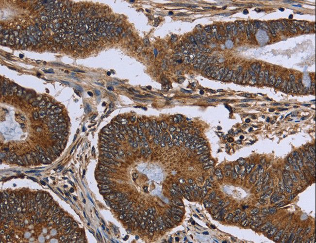 FHIT Antibody - Immunohistochemistry of paraffin-embedded Human cervical cancer using FHIT Polyclonal Antibody at dilution of 1:30.