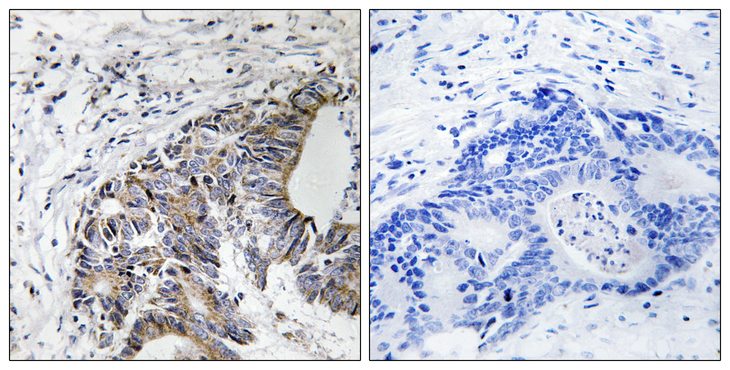 FHIT Antibody - Immunohistochemistry analysis of paraffin-embedded human colon carcinoma, using FHIT (Phospho-Tyr114) Antibody. The picture on the right is blocked with the phospho peptide.
