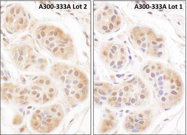 FHL2 Antibody - Detection of Human FHL2 by Immunohistochemistry. Sample: FFPE sections of human breast carcinoma. Antibody: Affinity purified rabbit anti-FHL2 ( Lot2 - left and Lot1 - right) used at a dilution of 1:1000 (1 Detection: DAB.