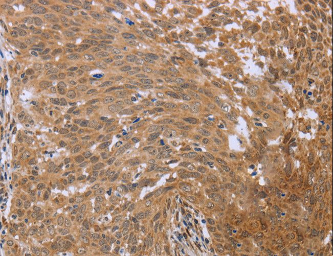 FHL2 Antibody - Immunohistochemistry of paraffin-embedded Human cervical cancer using FHL2 Polyclonal Antibody at dilution of 1:40.
