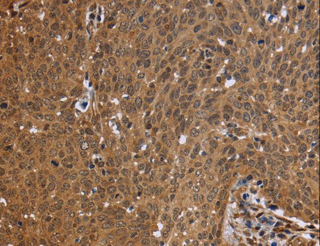 FHL2 Antibody - Immunohistochemistry of paraffin-embedded Human cervical cancer using FHL2 Polyclonal Antibody at dilution of 1:50.