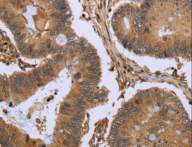 FHL2 Antibody - Immunohistochemistry of paraffin-embedded Human colon cancer using FHL2 Polyclonal Antibody at dilution of 1:50.