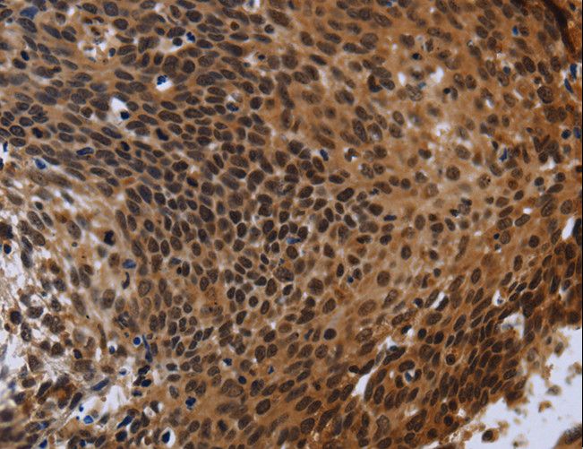 FHL3 Antibody - Immunohistochemistry of paraffin-embedded Human cervical cancer using FHL3 Polyclonal Antibody at dilution of 1:40.