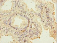 FIBP Antibody - Immunohistochemistry of paraffin-embedded human prostate cancer at dilution 1:100