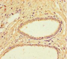FIG1 / IL4I1 Antibody - Immunohistochemistry of paraffin-embedded human prostate cancer at dilution 1:100