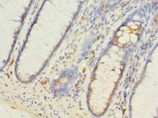 FILIP1L Antibody - Immunohistochemistry of paraffin-embedded human colon cancer using antibody at dilution of 1:100.