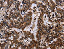 FIS1 Antibody - Immunohistochemistry of paraffin-embedded Human liver cancer using FIS1 Polyclonal Antibody at dilution of 1:20.