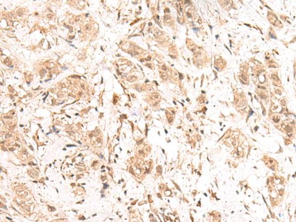 FIZ1 Antibody - Immunohistochemistry of paraffin-embedded Human breast cancer tissue  using FIZ1 Polyclonal Antibody at dilution of 1:40(×200)