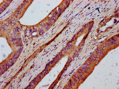 FKBP10 / FKBP65 Antibody - Immunohistochemistry Dilution at 1:400 and staining in paraffin-embedded human colon cancer performed on a Leica BondTM system. After dewaxing and hydration, antigen retrieval was mediated by high pressure in a citrate buffer (pH 6.0). Section was blocked with 10% normal Goat serum 30min at RT. Then primary antibody (1% BSA) was incubated at 4°C overnight. The primary is detected by a biotinylated Secondary antibody and visualized using an HRP conjugated SP system.