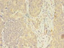 FKBP11 Antibody - Immunohistochemistry of paraffin-embedded human gastric cancer using antibody at dilution of 1:100.