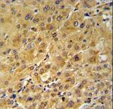 FKBP1A / FKBP12 Antibody - FKBP1A Antibody IHC of formalin-fixed and paraffin-embedded human hepatocarcinoma followed by peroxidase-conjugated secondary antibody and DAB staining.