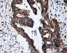 FKBP1A / FKBP12 Antibody - IHC of paraffin-embedded Adenocarcinoma of colon tissue using anti-FKBP1A mouse monoclonal antibody. (Dilution 1:50).
