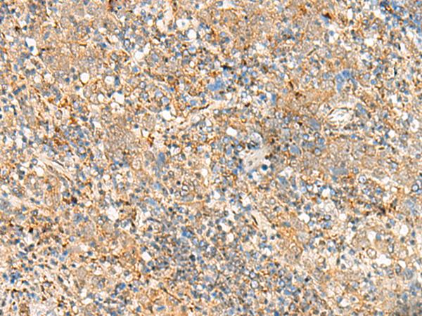 FKBP1A / FKBP12 Antibody - Immunohistochemistry of paraffin-embedded Human cervical cancer tissue  using FKBP1A Polyclonal Antibody at dilution of 1:55(×200)