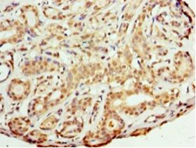 FKBP25 / FKBP3 Antibody - Immunohistochemistry of paraffin-embedded human breast cancer using antibody at 1: 100 dilution.  This image was taken for the unconjugated form of this product. Other forms have not been tested.