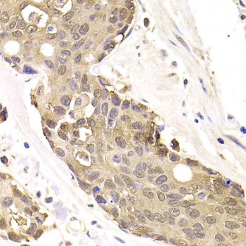 FKBP4 / FKBP52 Antibody - Immunohistochemistry of paraffin-embedded human colon cancer tissue.