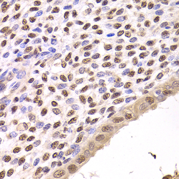 FKBP4 / FKBP52 Antibody - Immunohistochemistry of paraffin-embedded human adenomyosis.