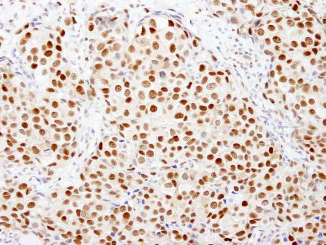 FKBP5 / FKBP51 Antibody - Detection of Human FKBP5/FKBP51 by Immunohistochemistry. Sample: FFPE section of human breast carcinoma. Antibody: Affinity purified rabbit anti-FKBP5/FKBP51 used at a dilution of 1:500.