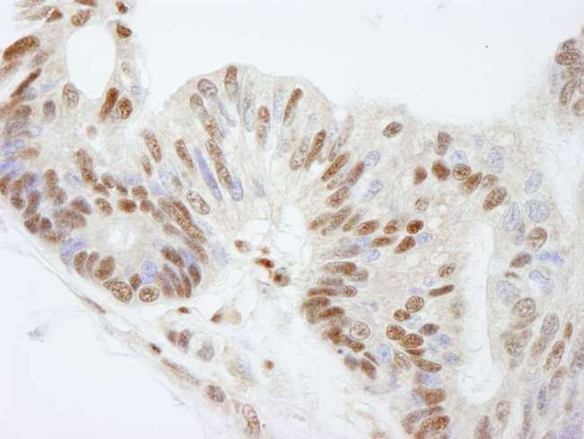FKBP5 / FKBP51 Antibody - Detection of Human FKBP5/FKBP51 by Immunohistochemistry. Sample: FFPE section of human ovarian carcinoma. Antibody: Affinity purified rabbit anti-FKBP5/FKBP51 used at a dilution of 1:500.