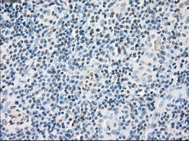 FKBP5 / FKBP51 Antibody - IHC of paraffin-embedded Carcinoma of thyroid tissue using anti-FKBP5 mouse monoclonal antibody. (Dilution 1:50).