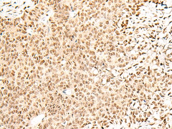FKBP5 / FKBP51 Antibody - Immunohistochemistry of paraffin-embedded Human ovarian cancer tissue  using FKBP5 Polyclonal Antibody at dilution of 1:50(×200)