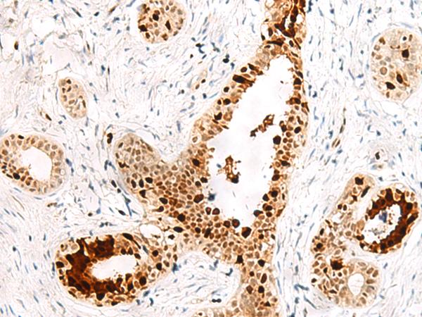 FKBP5 / FKBP51 Antibody - Immunohistochemistry of paraffin-embedded Human breast cancer tissue  using FKBP5 Polyclonal Antibody at dilution of 1:50(×200)