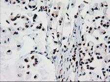 FKBPL Antibody - IHC of paraffin-embedded Adenocarcinoma of Human colon tissue using anti-FKBPL mouse monoclonal antibody. (Heat-induced epitope retrieval by 10mM citric buffer, pH6.0, 100C for 10min).