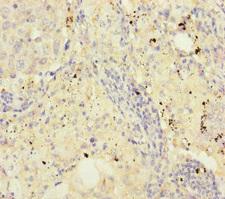 FKBPL Antibody - Immunohistochemistry of paraffin-embedded human lung cancer at dilution of 1:100