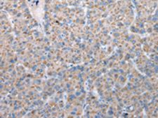 FKBPL Antibody - Immunohistochemistry of paraffin-embedded Human liver cancer tissue  using FKBPL Polyclonal Antibody at dilution of 1:50(×200)